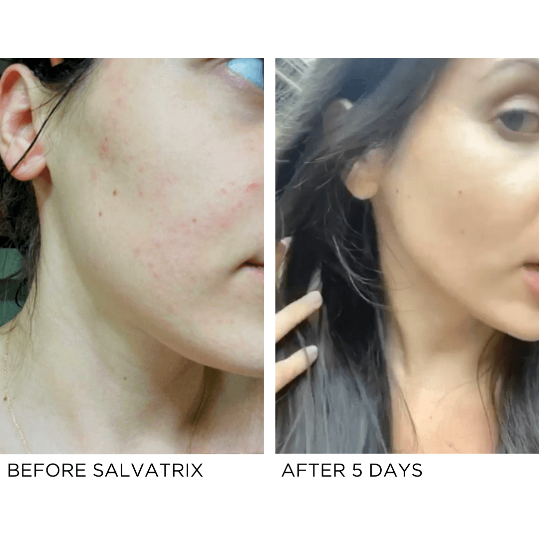 Salvatrix | Anti-Blemish Serumcategory_Skincare from Kalos - SHOPELEOS